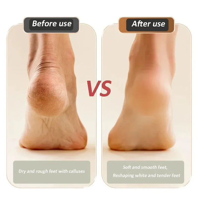 🎉 2026 Flash Sale — Over 80,000 Sold! 🔥 USB Rechargeable Electric Foot Callus Remover – 3‑Speed Grinding & LED Light 👣